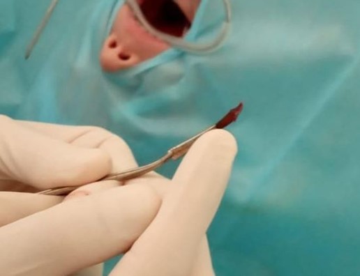 Врачи спасли четырехлетнюю девочку с кисточкой в голове