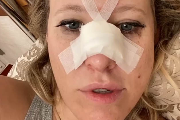 Собчак получила перелом носа и сотрясение мозга после неудачного падения