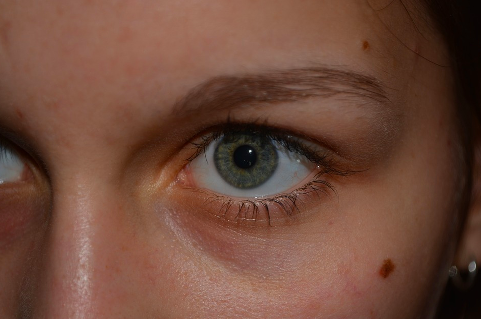 Онкологи рассказали, как часто нужно проверять родинки