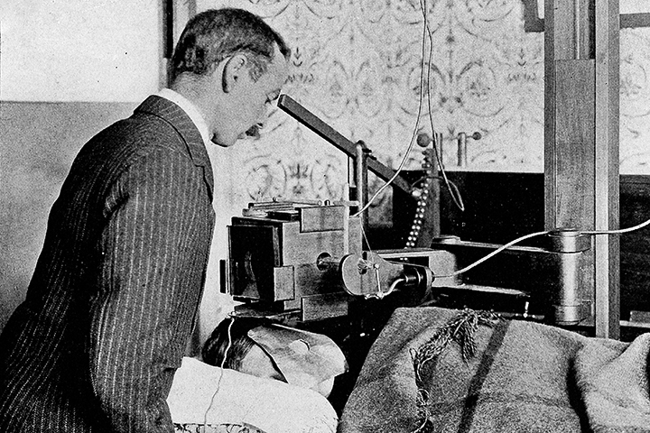 Так проводилась рентгенотерапия в 1902 году. Для без- опасности вокруг вакуумная трубка прикрыта специальным щитом