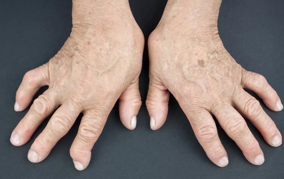 Врачи назвали провоцирующие развитие артрита напитки