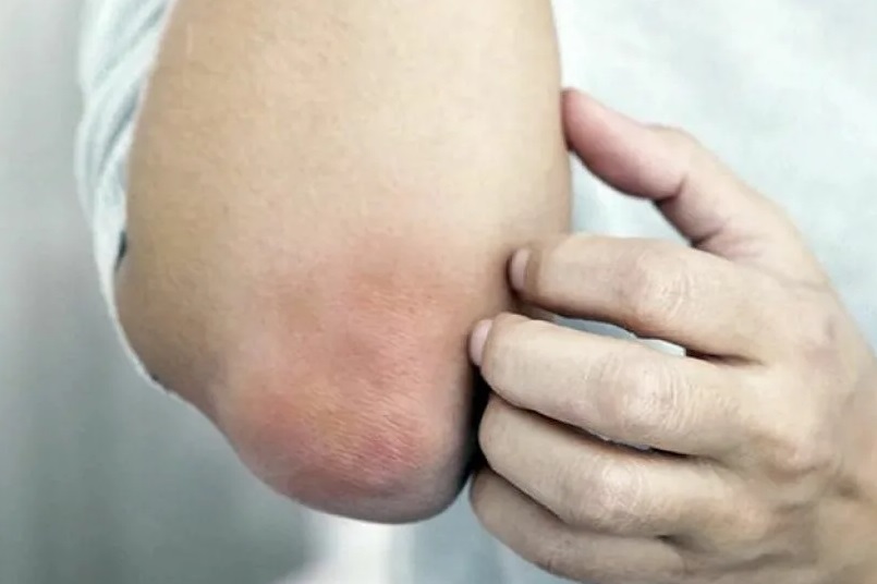 Дерматолог перечислила связанные с шелушащимися локтями болезни