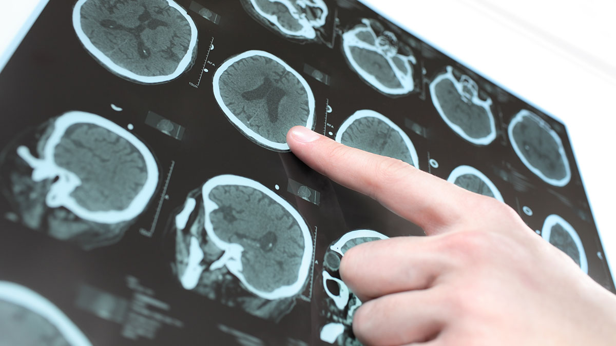 Врач рассказала, что предвещает наступление инфаркта и инсульта