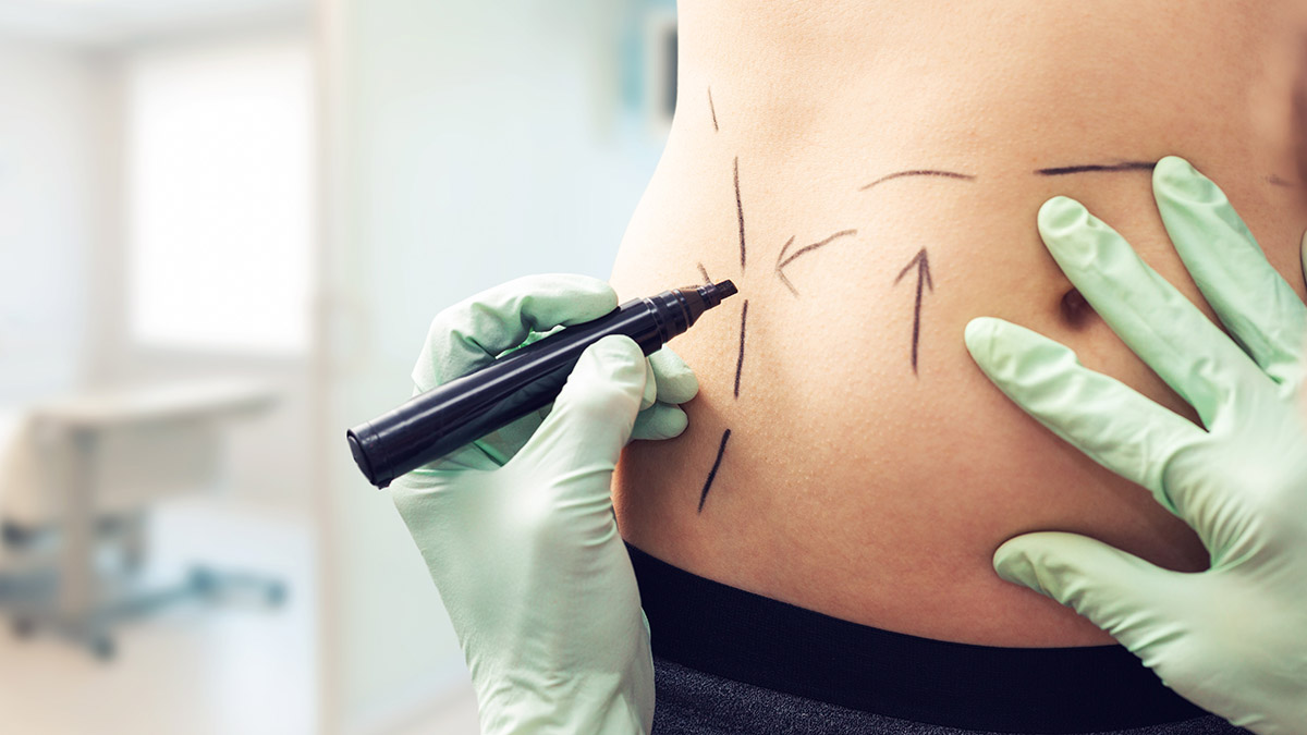 «Остаются косвенные признаки»: пластический хирург оценил результат быстрого похудения Анны Седоковой