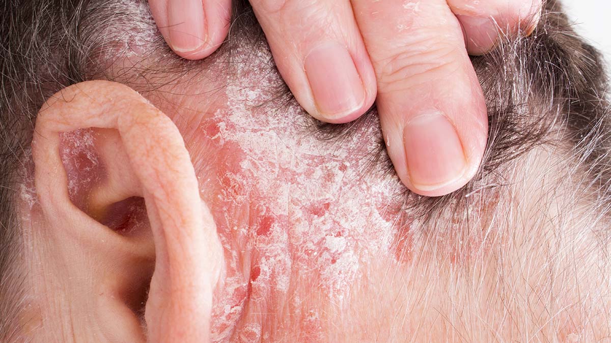 Дерматолог раскрыл, как избавиться от чешуек кожи на голове