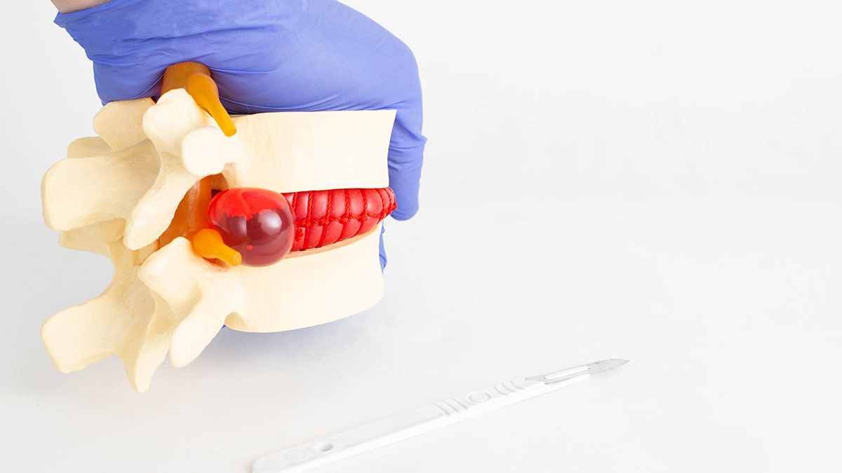 Травматолог назвал три симптома начинающейся грыжи позвоночника