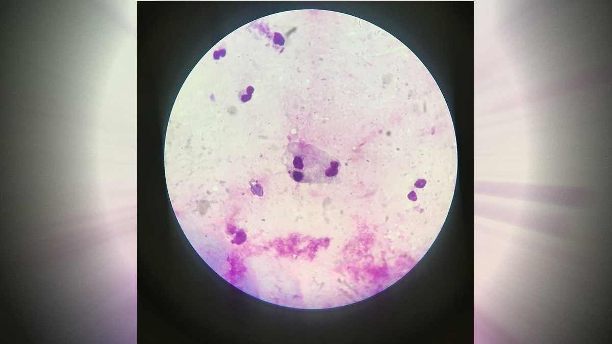 «Поражает глаза»: названа опасная разновидность амеб, обитающих в пресной воде