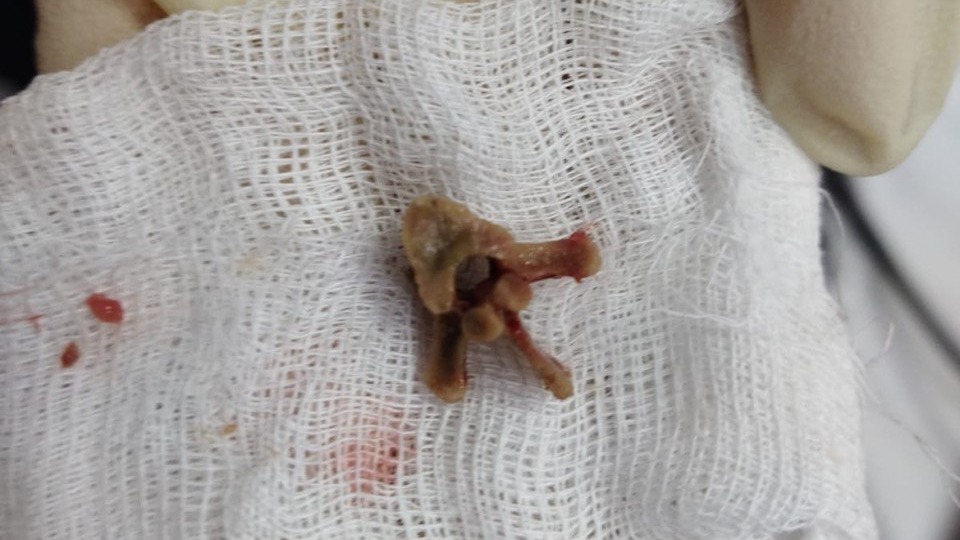 У жителя Подмосковья развилась пневмония из-за неудачно съеденного куриного позвонка