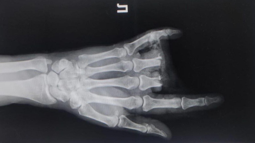 Житель Подмосковья отрезал себе два пальца болгаркой