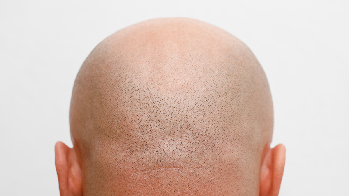 Российские школьники начали лысеть из-за стресса