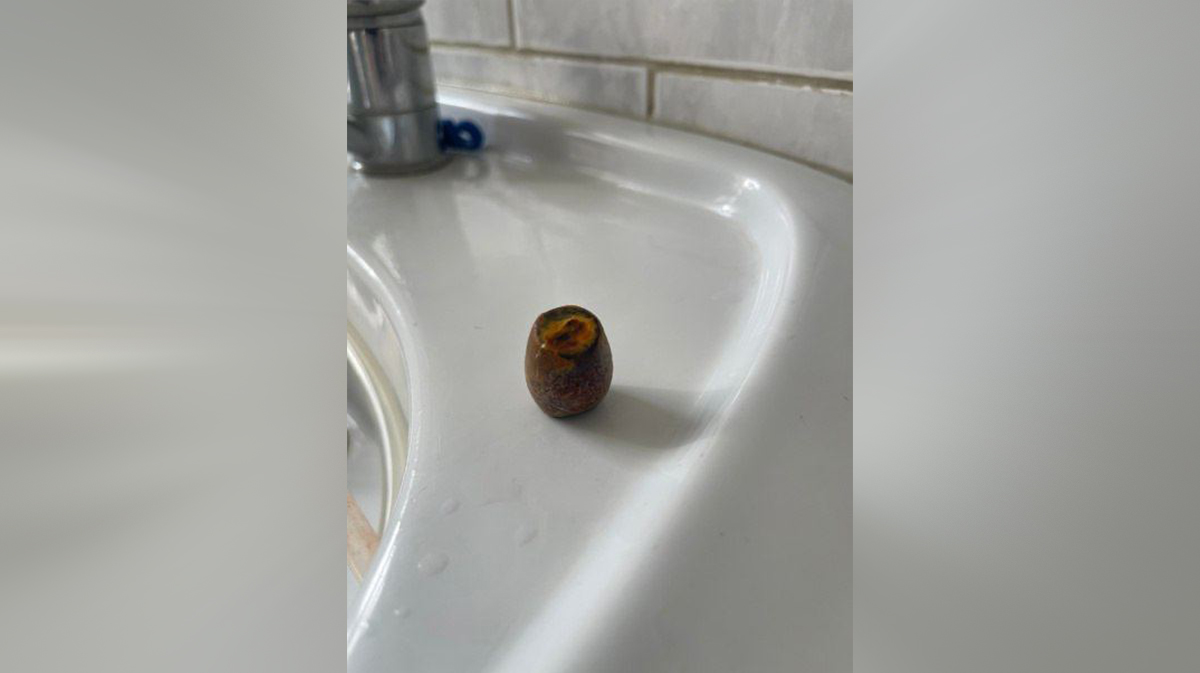 Подмосковные врачи удалили пациентке желчный камень в форме бочонка лото