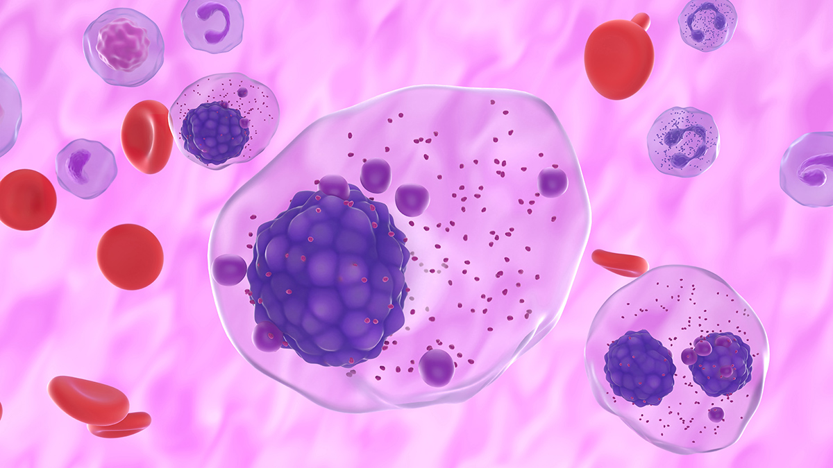 Что такое миеломная болезнь и какие у нее симптомы 