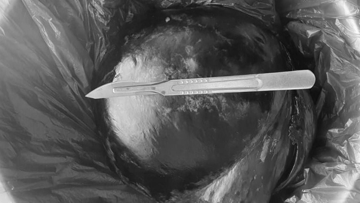 Подмосковные врачи удалили пациентке опухоль размером с арбуз