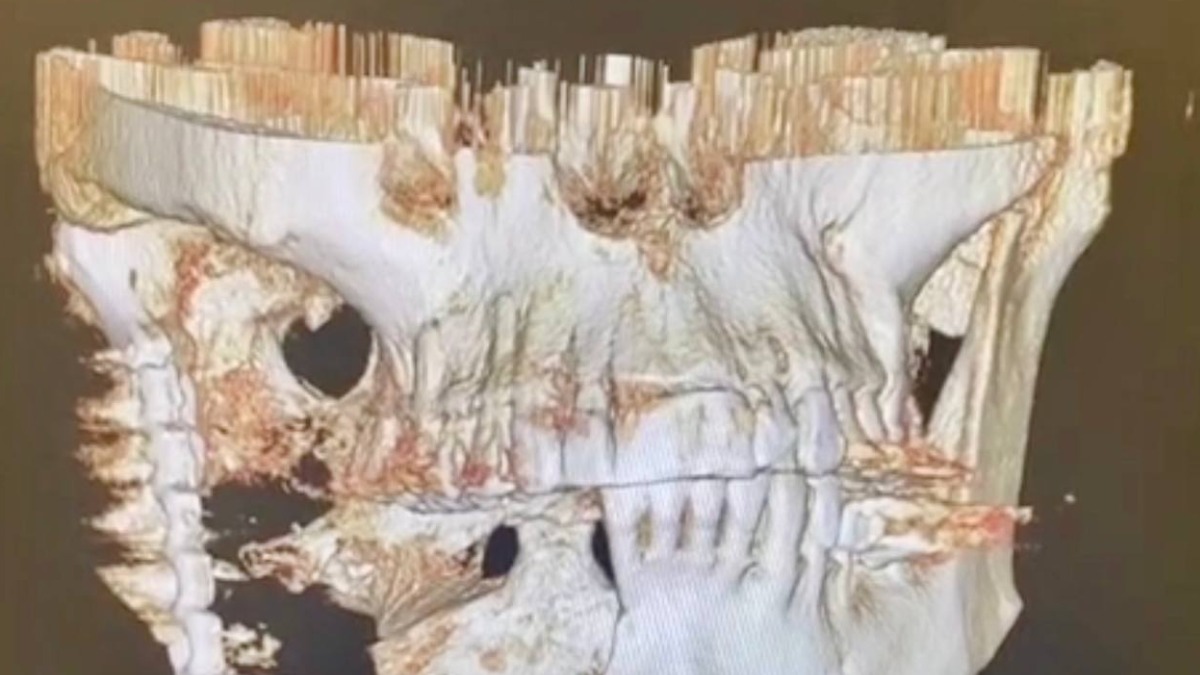 Женщина заболела раком и лишилась части челюсти после родов в Подмосковье