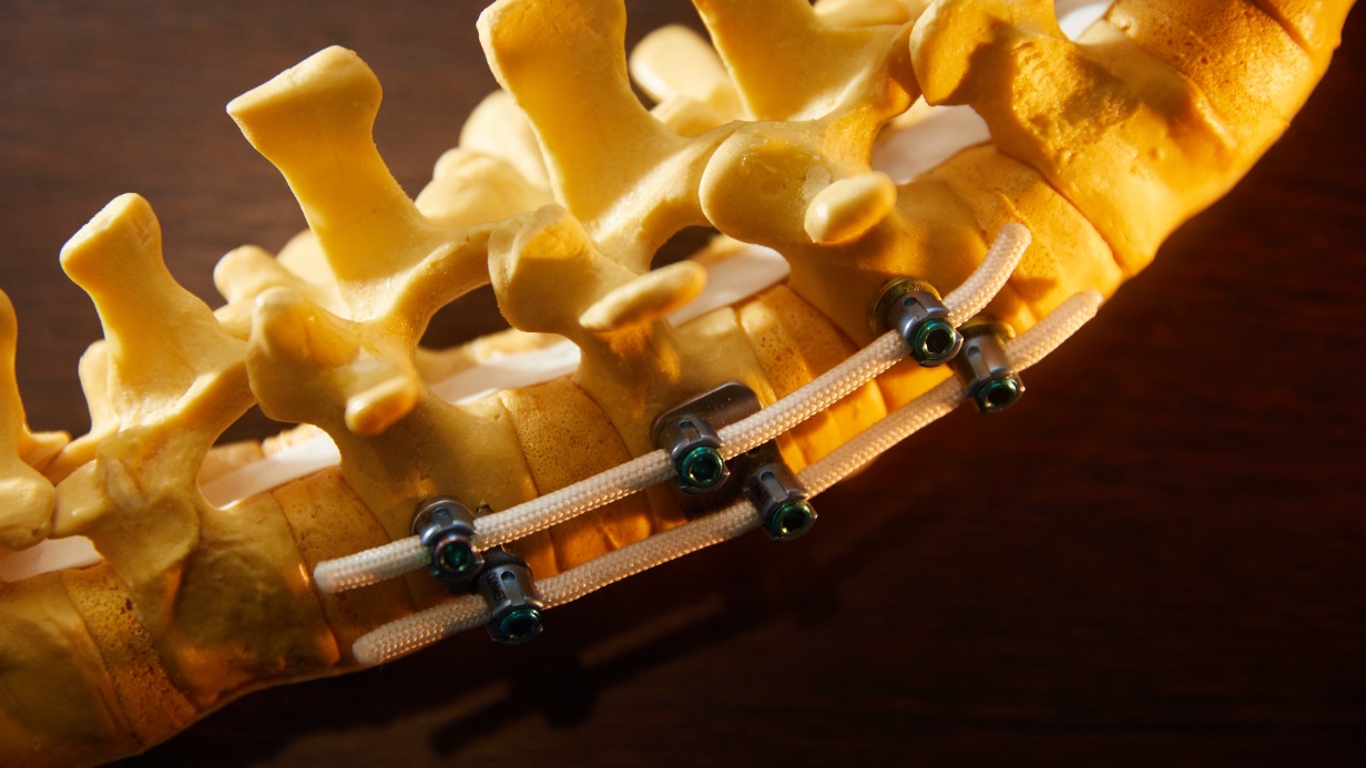 Столичная разработка помогает лечить сколиоз