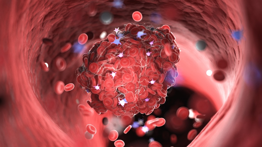 Как узнать, есть ли у тебя тромбы