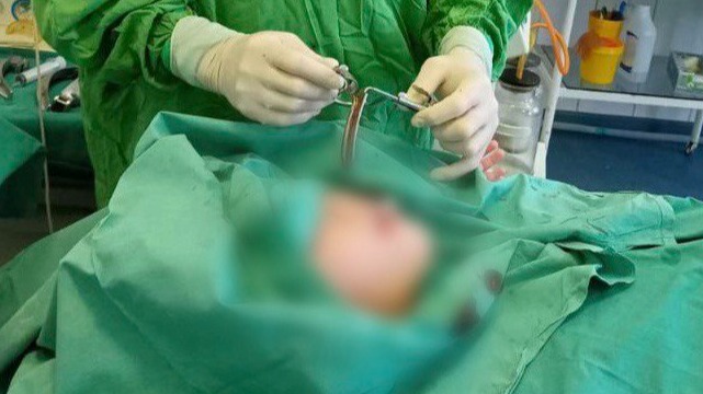 Подмосковные врачи спасли парализованную из-за отита женщину