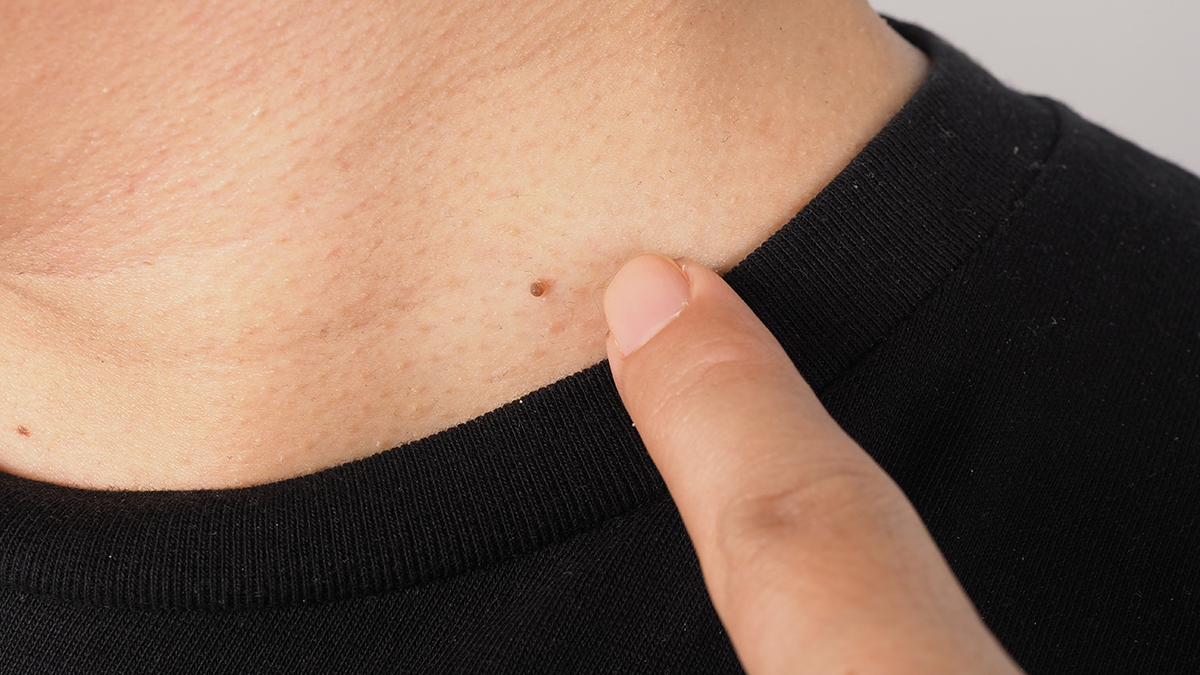 Почему возникают папилломы и как от них избавиться