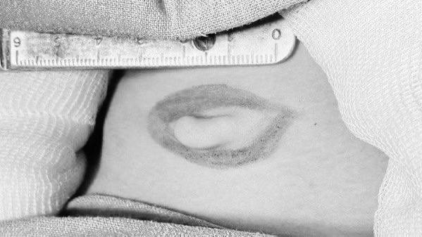 Врачи Видновской больницы прооперировали ребенка с жабрами