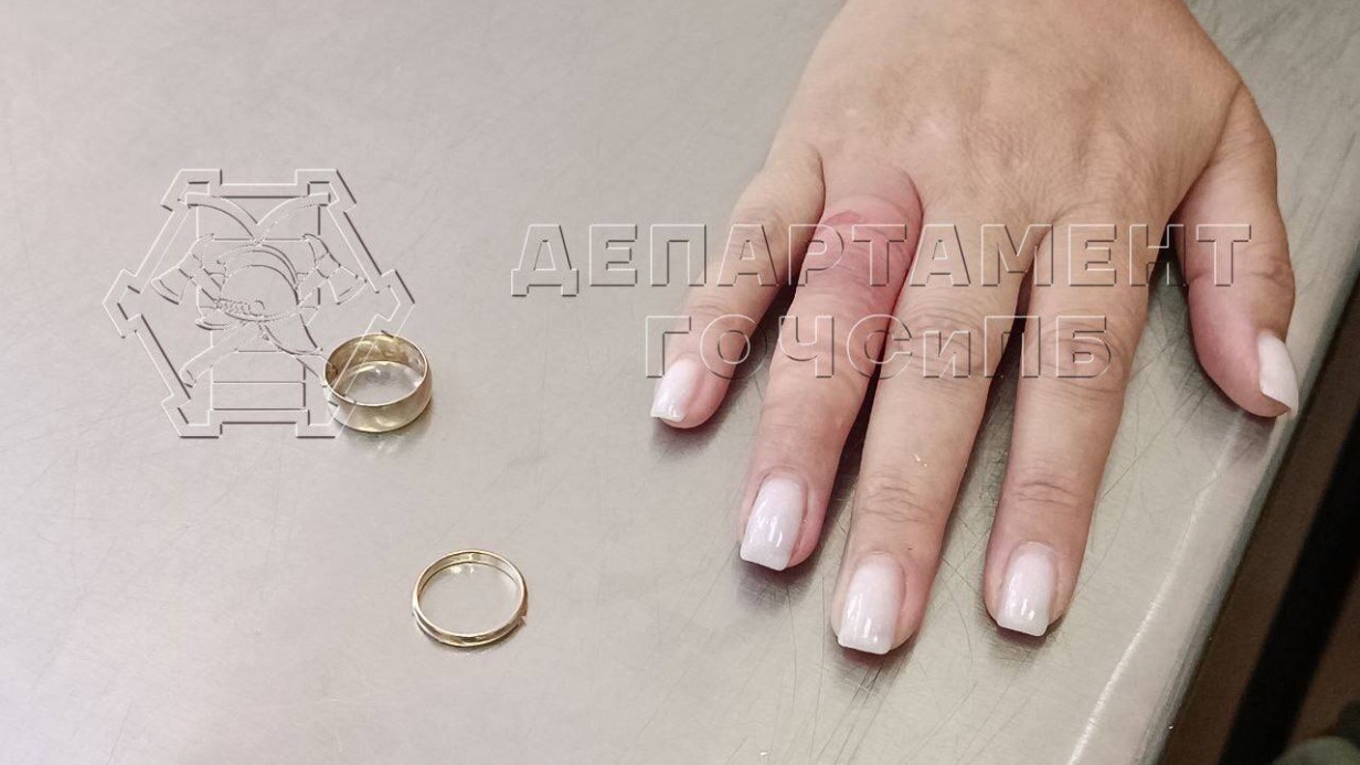 Спасатели помогли москвичке снять кольца с распухшего пальца