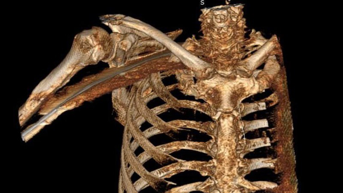 Житель Подмосковья чудом выжил после падения на 60-сантиметровый кусок арматуры