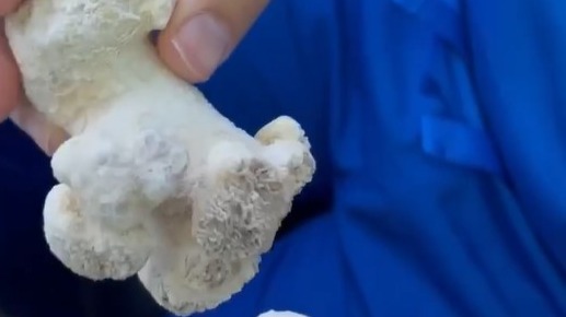 Врач Гадзиян рассказал о спасении пациента с коралловидным камнем в почке