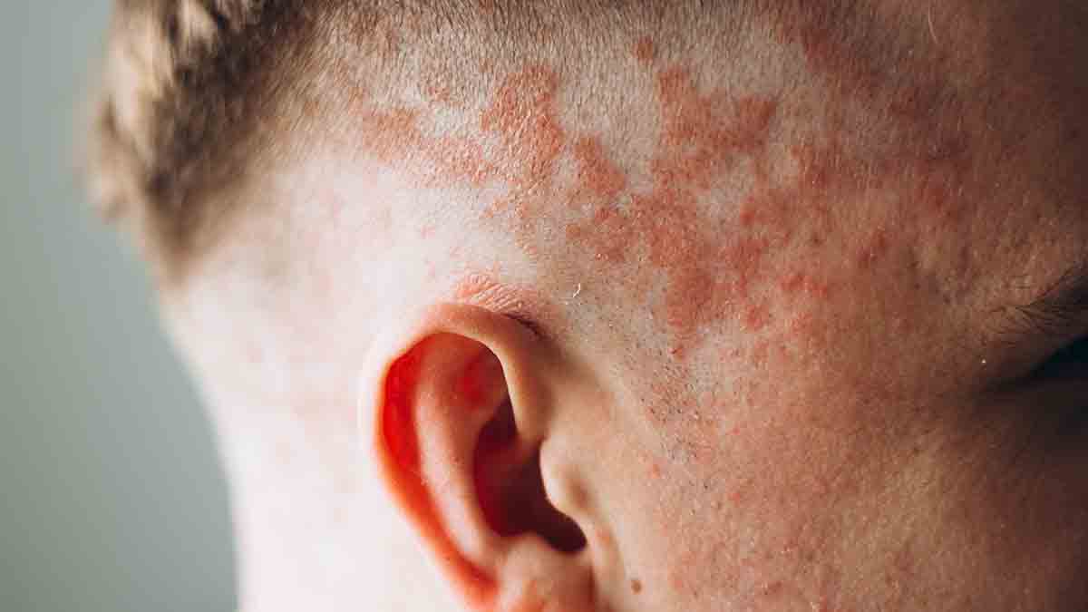 Почему возникает псориаз и как облегчить его течение