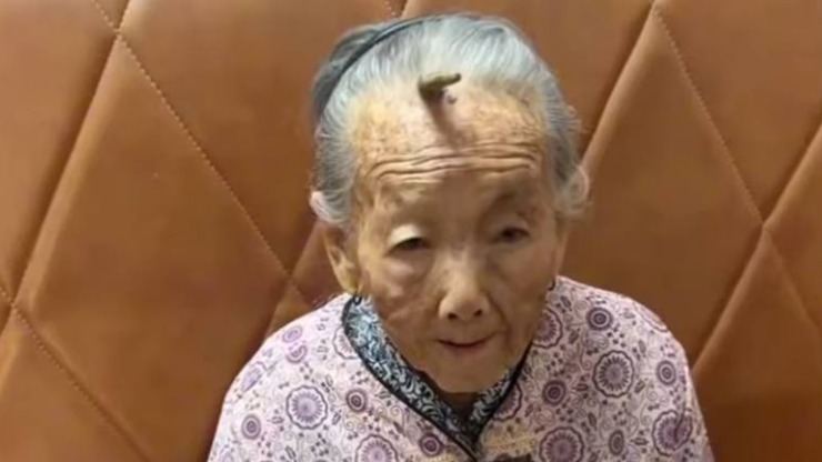 10-сантиметровый рог вырос на лбу у 107-летней долгожительницы из Китая