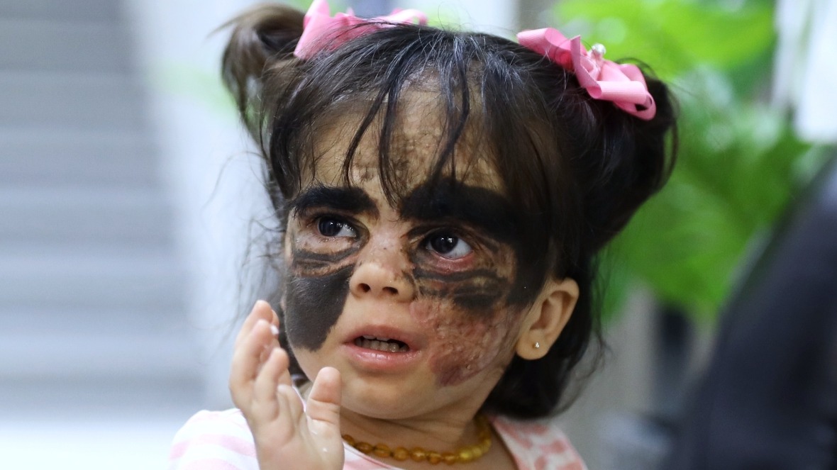 Девочка с «маской Бэтмена» из США не может оплатить операцию в России из-за санкций