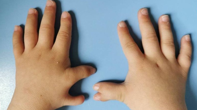 Мальчика с 12 пальцами на руках прооперировали в Московской больнице