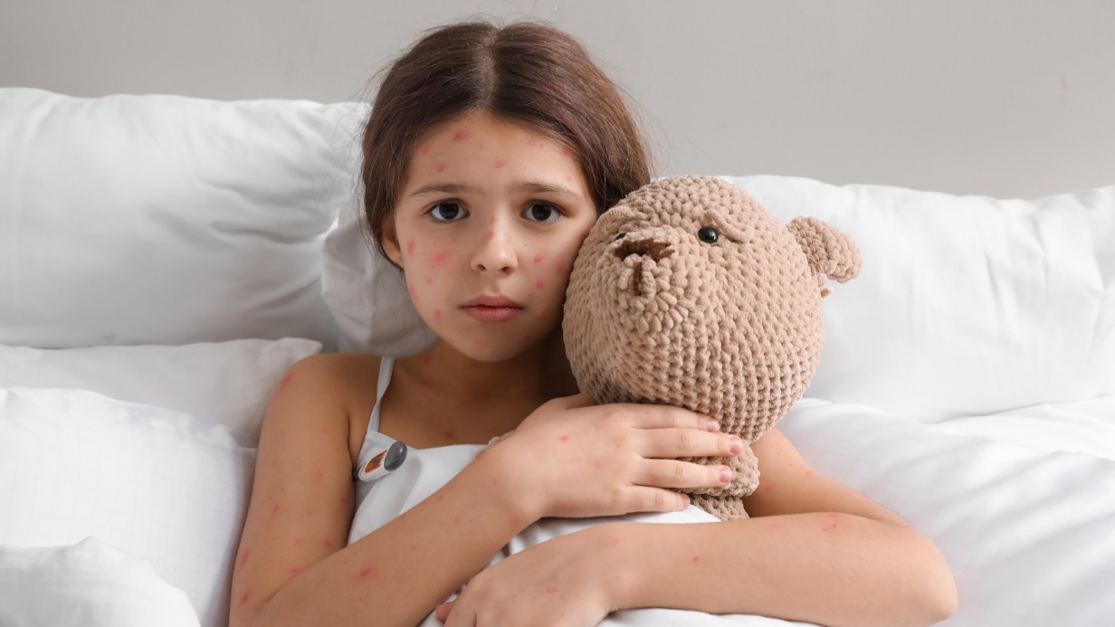 Основной признак ветрянки у детей — это красные высыпания на коже и высокая температура