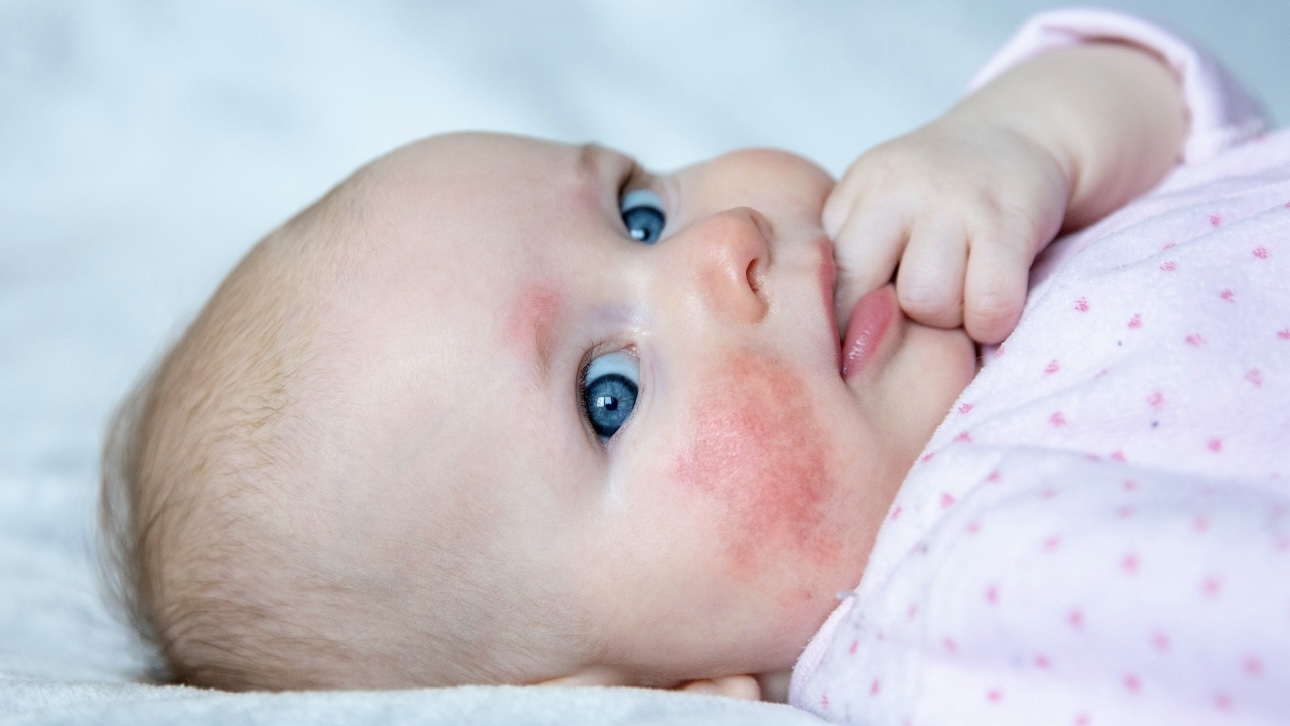 Сипмтомы скарлатины