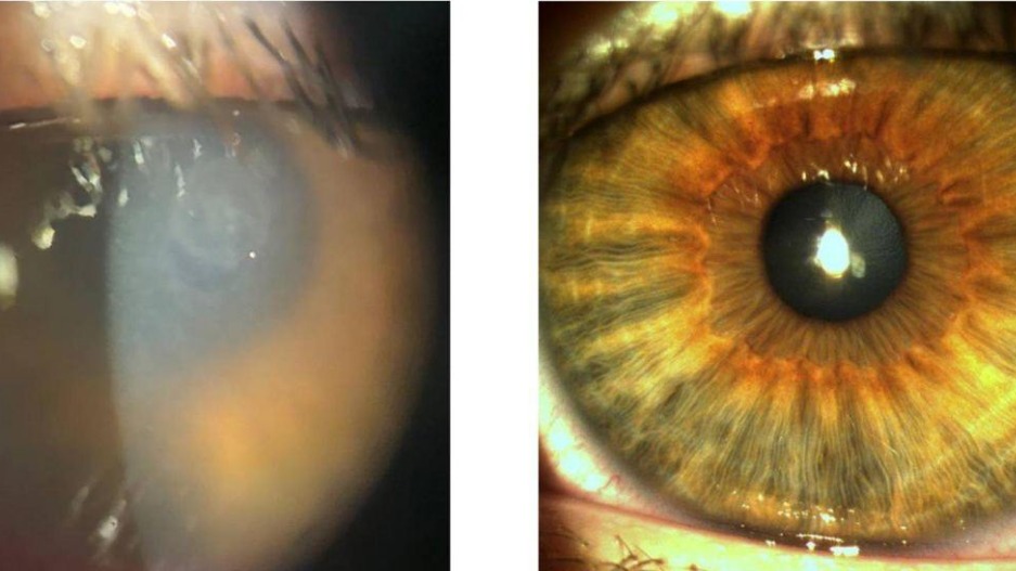 Подмосковные врачи спасли зрение подростку, не снимавшему линзы три месяца
