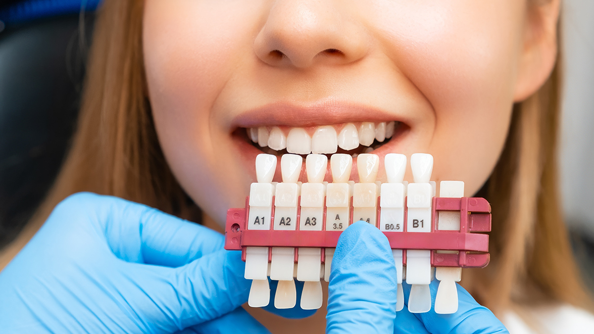 Почему молодежь меняет здоровые зубы на виниры