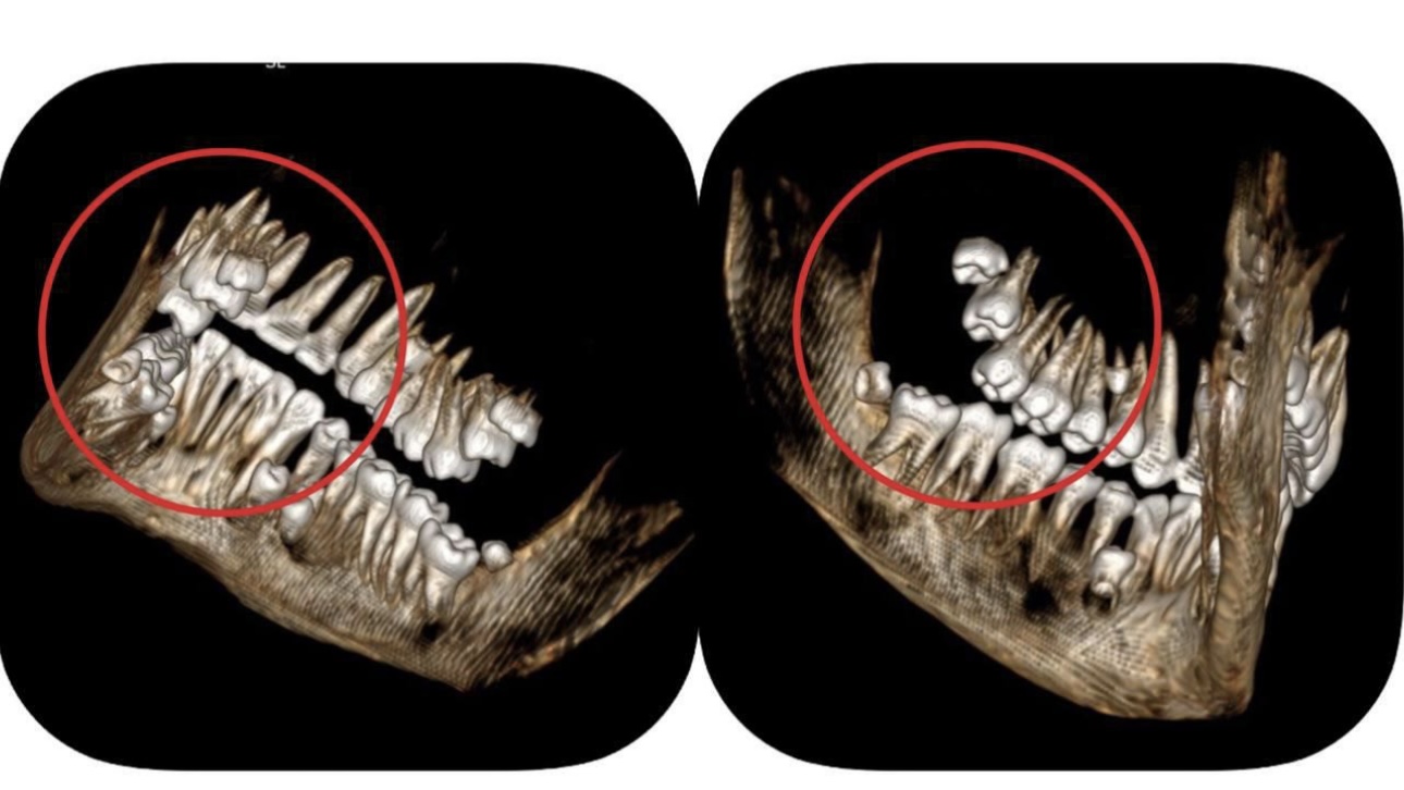 Почему могут вырасти лишние зубы