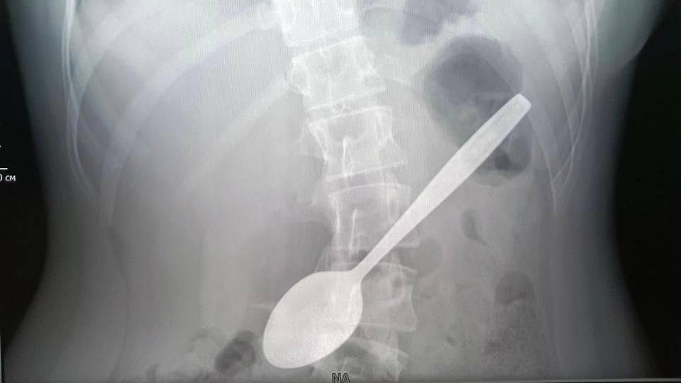Подмосковные врачи достали из желудка школьницы 15-сантиметровую ложку