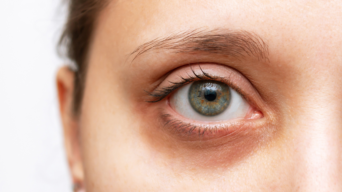 Что такое синдром сухого глаза, почему он возникает и кто в группе риска