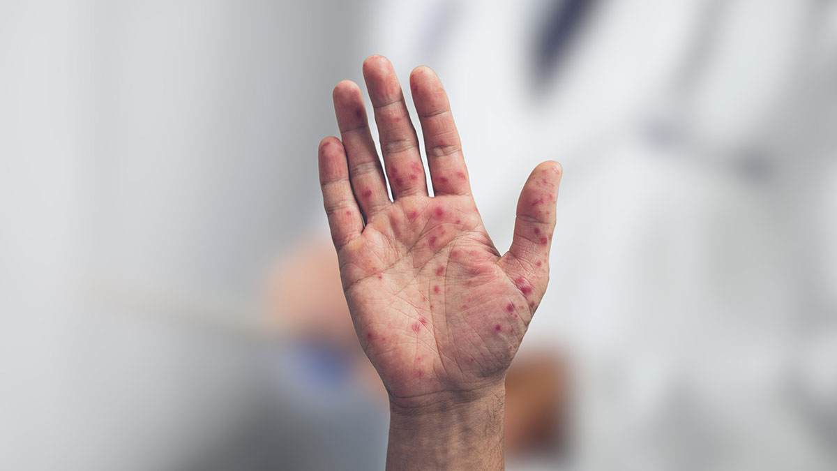 В Роспотребнадзоре оценили ситуацию с вирусом Коксаки в РФ