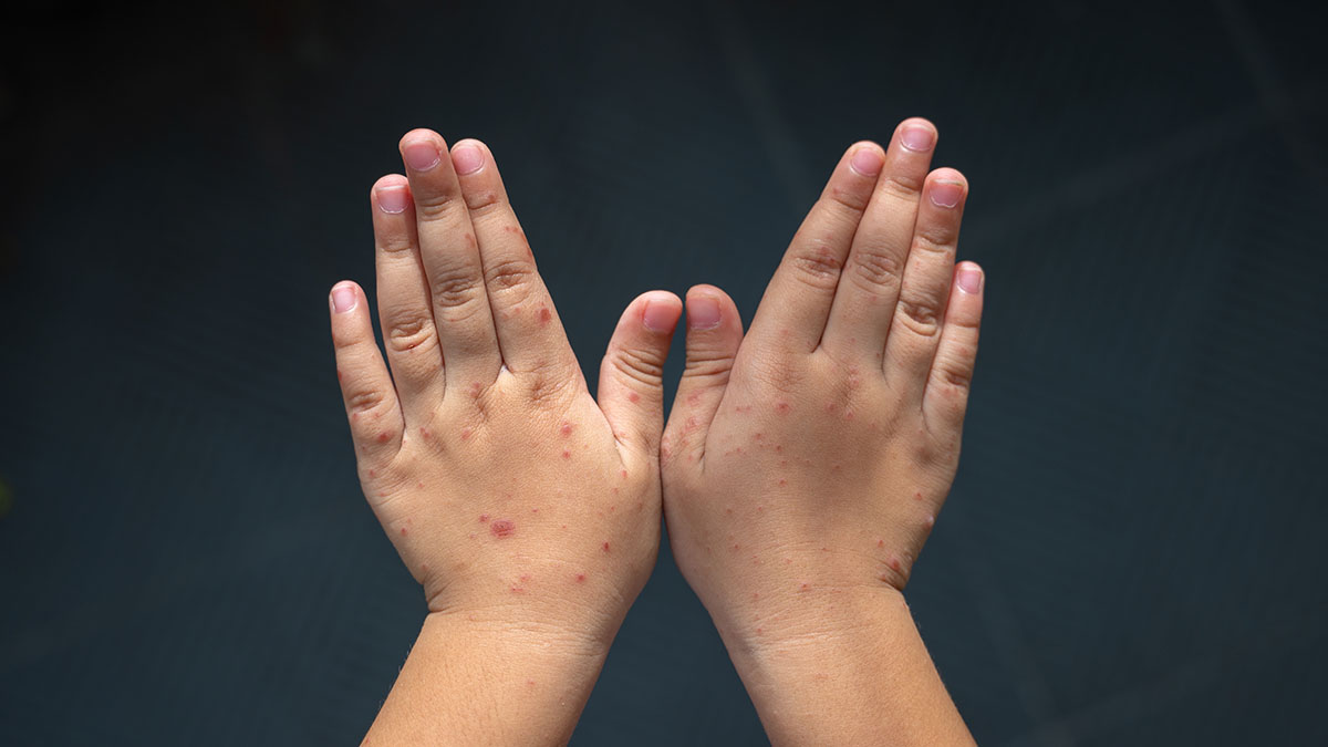 СМИ: Маленький ребенок покрылся жуткой сыпью на отдыхе в Таиланде