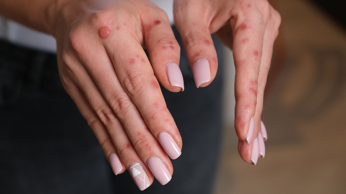 Заслуженный врач Осипов рассказал о характере осложнений вируса Коксаки