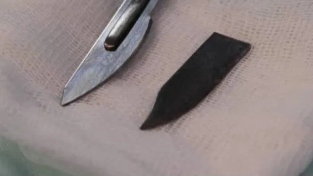 Нож, извлеченный врачами из черепа пациента