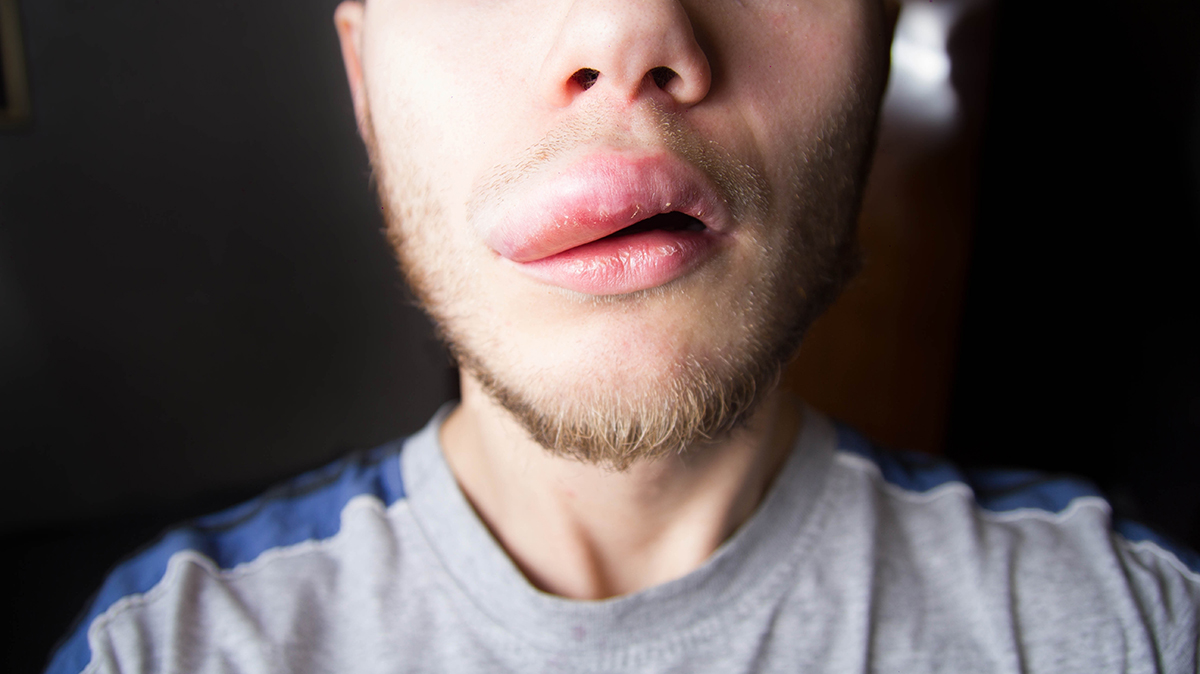 Какие продукты вызывают отек Квинке