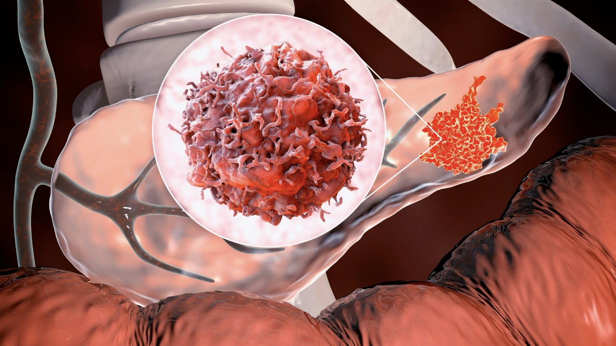 Рак поджелудочной железы: признаки