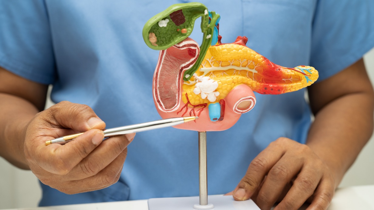 Что такое панкреонекроз