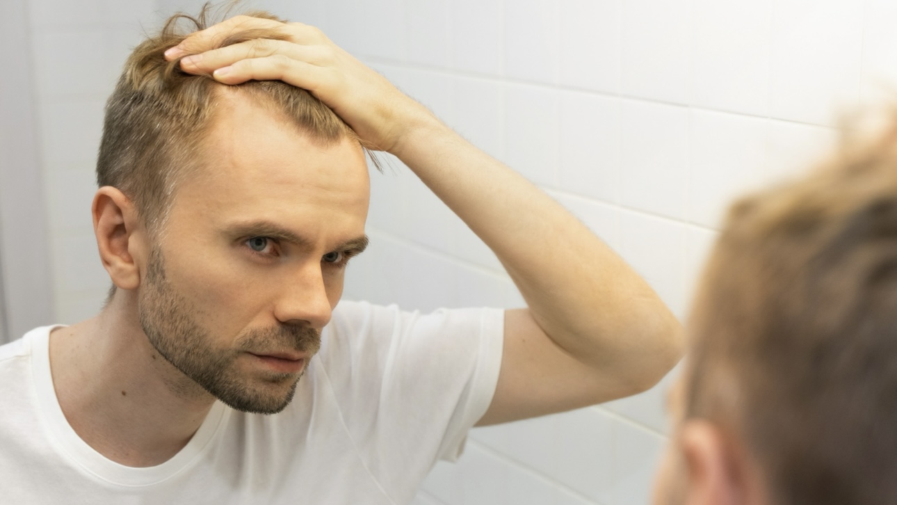 Как лечить алопецию