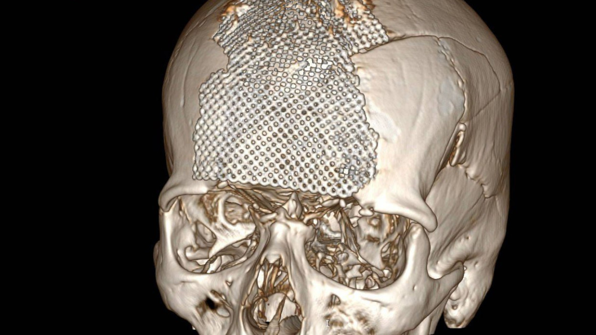 Солдата СВО с почти полностью разрушенным черепом спасли в Екатеринбурге