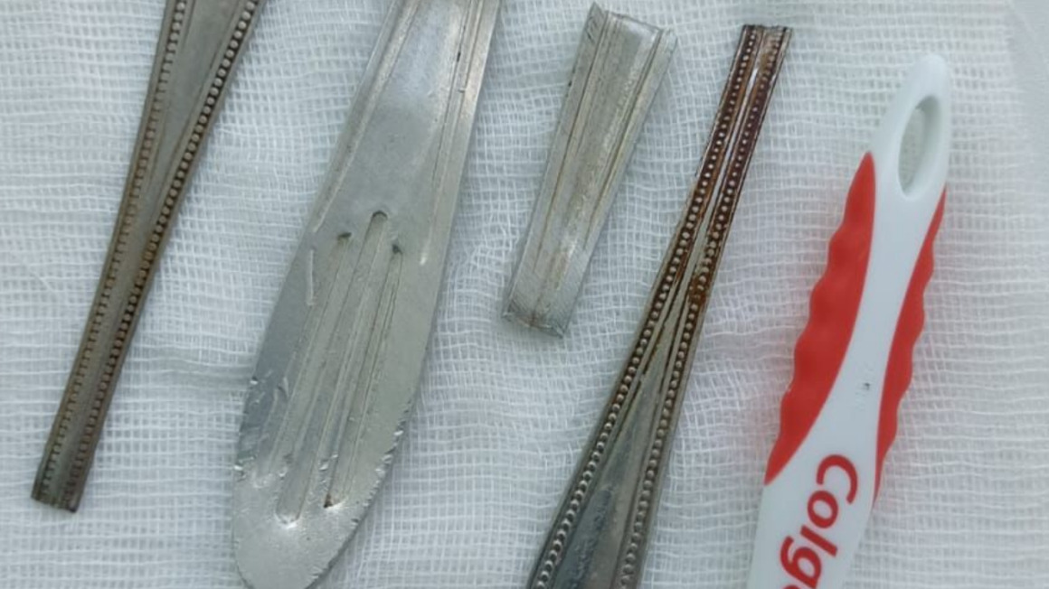 Врачи в Башкирии достали из мужчины столовые приборы и зубную щетку