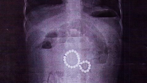 Двухлетняя девочка проглотила 29 магнитных шариков в Иркутске