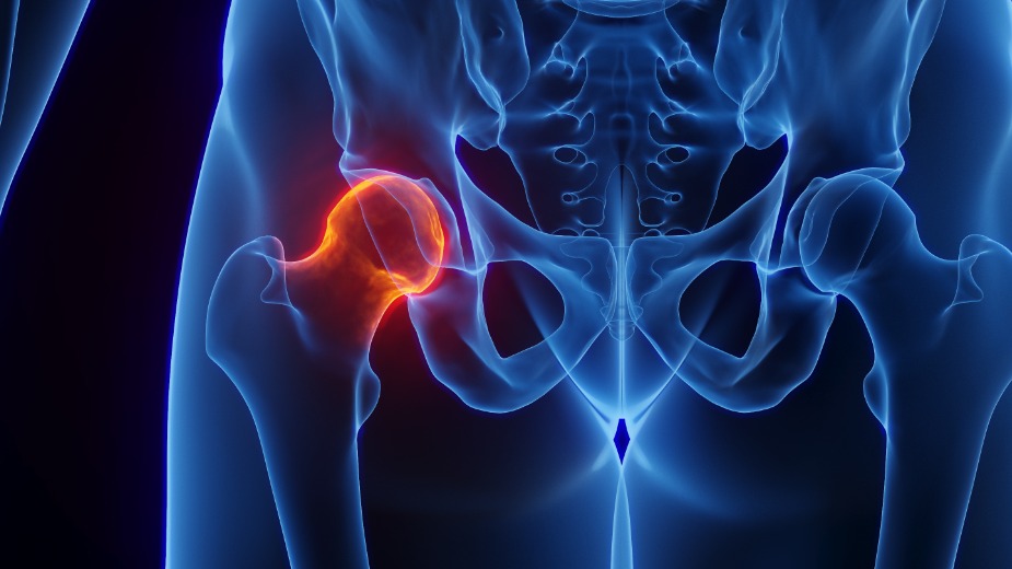 Замена тазобедренного сустава: риски, восстановление, операция