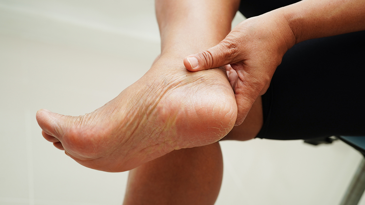 Пенсионер из Британии сгорел заживо из-за увлажняющего крема для ног